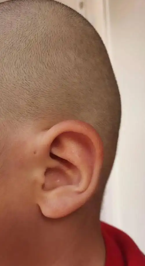 丹凤眼:这个是腮裂瘘管,先天性的发育不好没有闭合,一般长在耳前厚