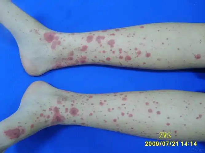 典型---变应性血管炎 - 皮肤及性传播疾病讨论版 - 爱爱医医学论坛
