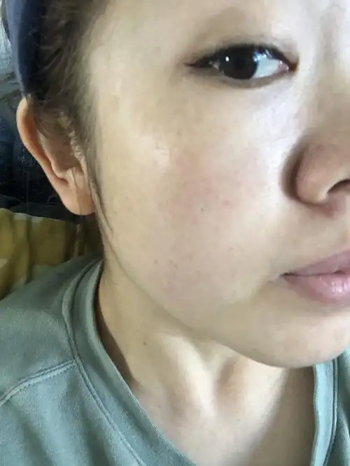 掉痂的地方呈白色肤色不均匀