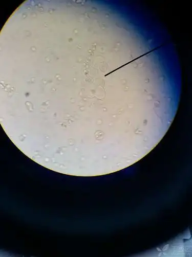 zyh 2013-03-24 15:01 同一尿中出现的,这个可以叫做大圆上皮细胞吗?