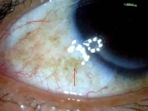 紫外线照射过多引起的睑裂斑