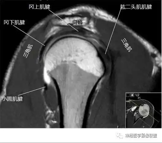 影像解剖肩关节磁共振断层