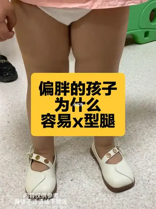 胖宝宝的x型腿
