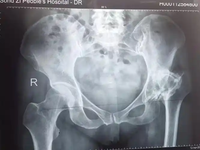 髋关节发育不良 长短腿手术治疗 - 好大夫在线