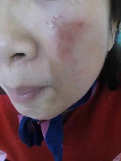 脸上长癣图片 (14)_有来医生