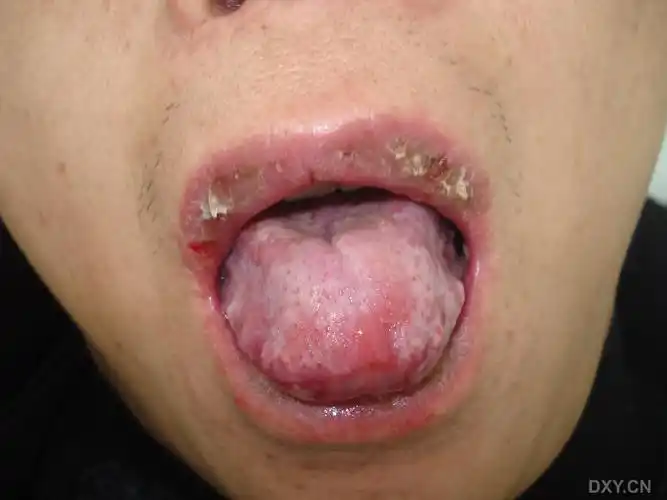 不断增多的红斑和丘疹. [病例帖]