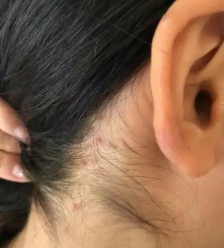 租客被红蚂蚁咬伤想退款遭青岛美丽屋房产中介拒绝