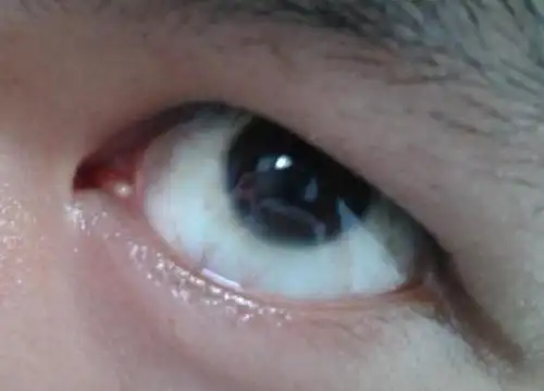 眼球旁边长了一个小白点是什么?要不要紧?