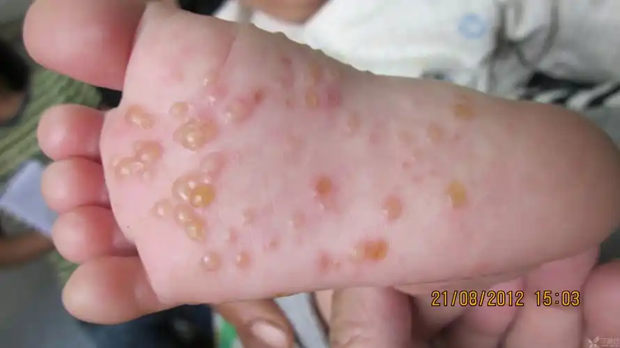 【原创】双手及双足水痘疹半个月,什么病? [病例帖]