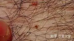 我们单位的好几个男的都结扎了,男人结扎有什么好处和坏处啊?