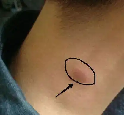 【报警】脖子莫名起包块,很可能是肿瘤?专家教你初步识别