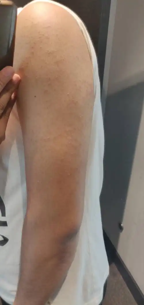 两个胳膊上部长很多类似粉刺痘痘不痛不痒好多年了,怎么治疗?影响美观