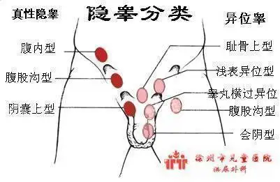 手术的目的是将睾丸牵引固定到阴囊内,手术是否成功取决于患儿精索