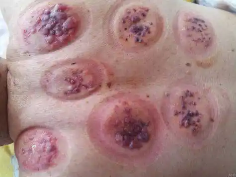 拔火罐时,后背吸出来的瘀血,或是身体的垃圾毒素?真相来了