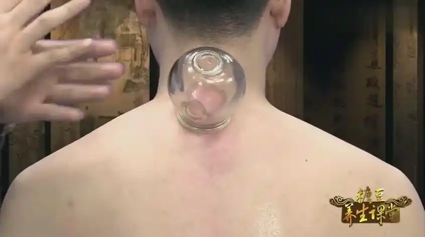 感冒头疼拔罐的位置示意图视频在线观看 - 西瓜视频