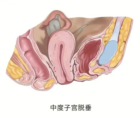 中重度子宫脱垂