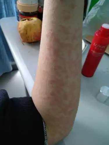 怎么回事,发烧,起红疹