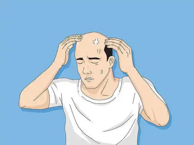 矢量-脱发卡通,青年男女严重脱发问题为脱发概念矢量插图.001图片下载