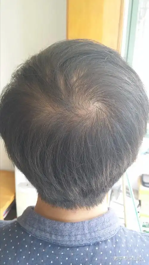 我头顶漩涡头发的发量正常吗