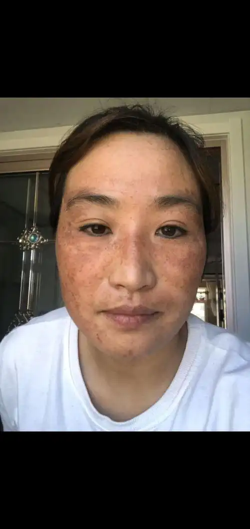 严重的黄褐斑真皮斑及色素回流洗斑液一瓶搞定.