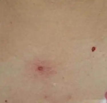 乙肝小红点图片