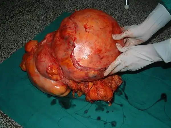 【湘雅普外记录之一】一例罕见巨大脂肪肉瘤报告.