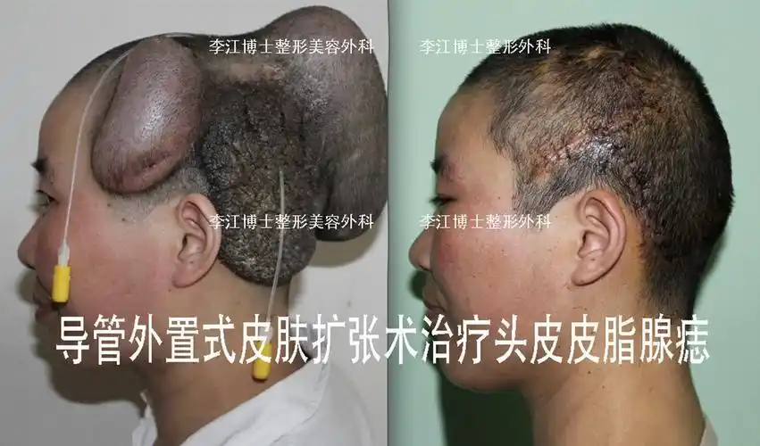 皮脂腺痣手术治疗(配多彩图 )_发生