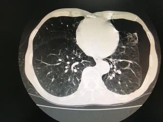 高龄肺气肿合并肺大泡气胸并非手术禁区! - 好大夫在线