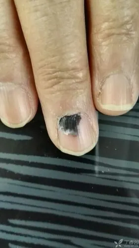 【求助】请问这是甲下黑色素瘤吗 cheerio 2016-02-21 22:54   关注