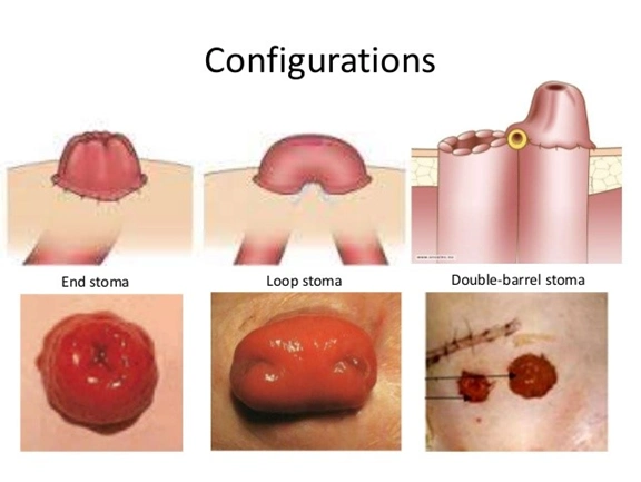 肠造口认识与护理须知如何科学地管理肠造口