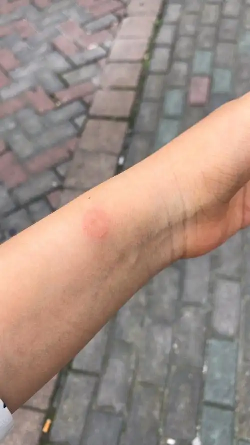 关于铜钱癣的初期发展治疗好转