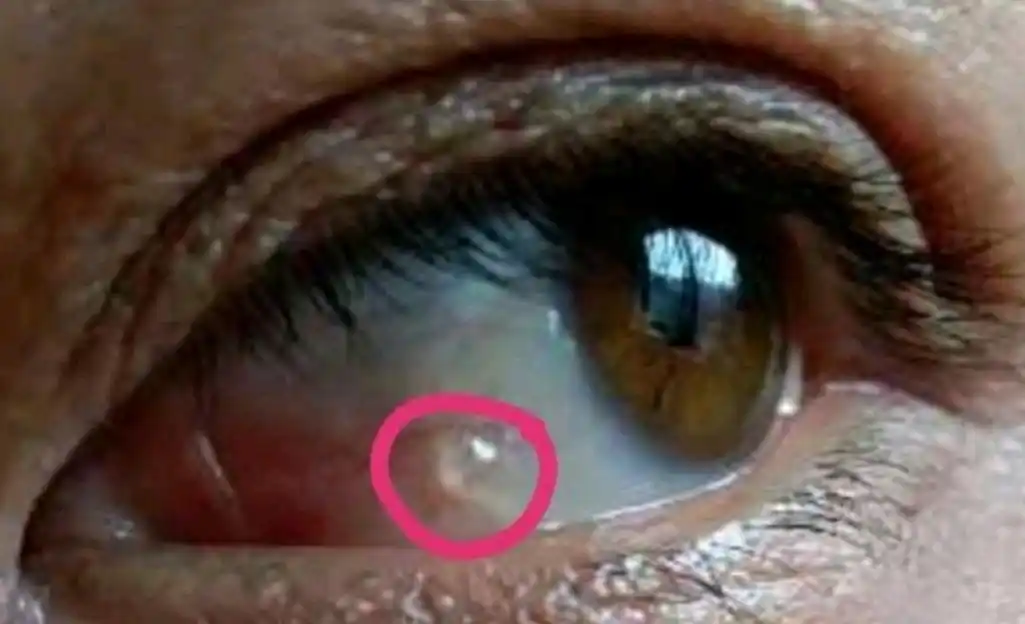 眼白上的"鱼泡泡"是咋回事?
