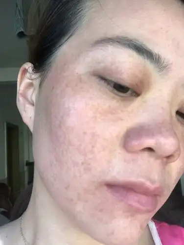 4.5雀斑 黄褐斑无创技术