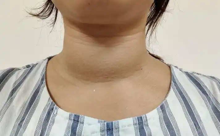 妙龄女子得了大脖子病病因为何医生病根在脑子