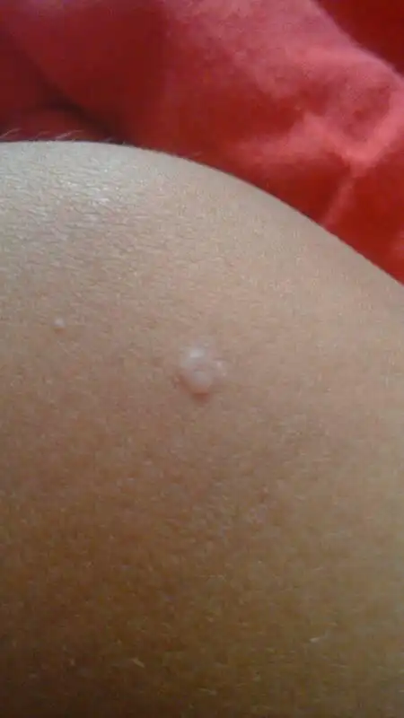 我皮肤上起了疙瘩白色的