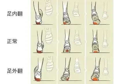笔直大长腿 | 足弓高低与足内翻足外翻的关系