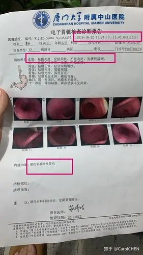 反流性食管炎治愈心路历程——给同患病的大家一剂正能量 - 知乎