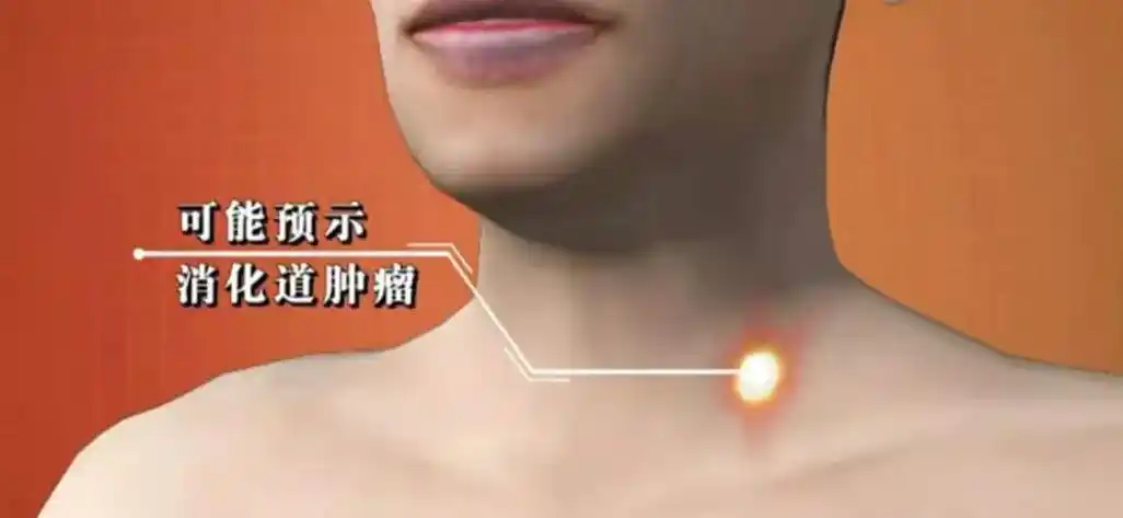 左侧锁骨上方若出现癌症病变,最常见的是食管癌和胃癌.