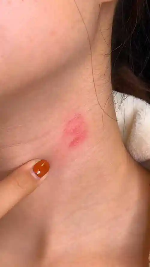 草莓印这样处理老师绝对看不出来