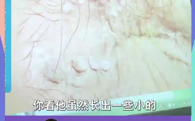 44肛周尖锐湿疣症状图片