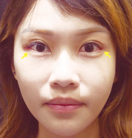 眼睛放大术 开眼尾 内.外眼睑下置术