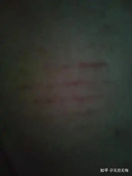 后背出现四道划痕