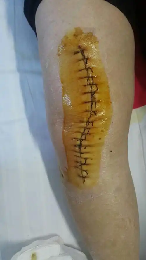 我院一例75岁女性.双膝置换前后图片.胆小误入.