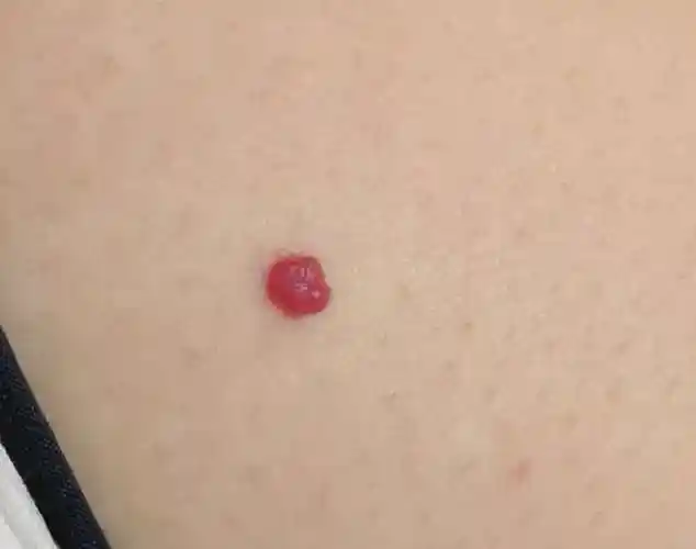 医生您好我右边胸部长了这个红痣好像越来越突出了而且长