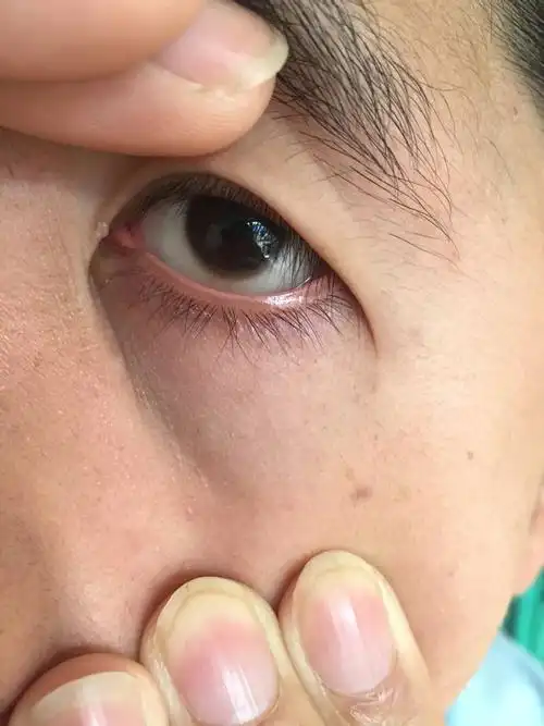 我老公的眼睛我今天发现有灰色的东西,右眼多,左眼下方也有,请问一下