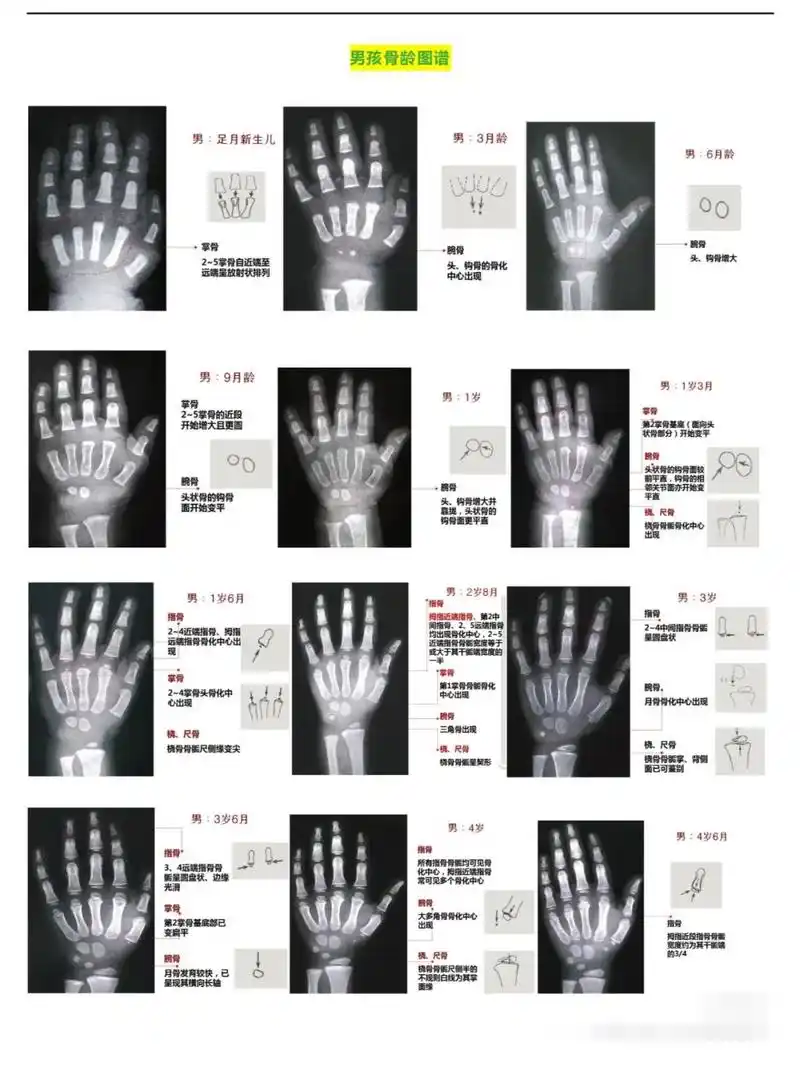 13.6男孩骨龄片对照图谱