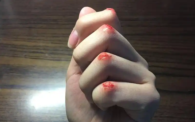 指关节擦伤(轻微)part1