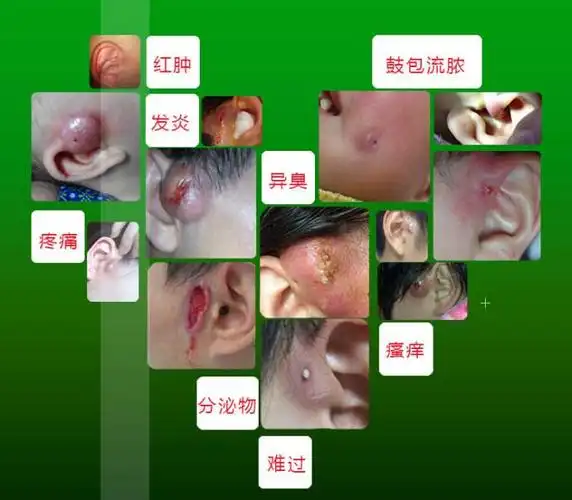 耳前瘘管发炎如何消肿