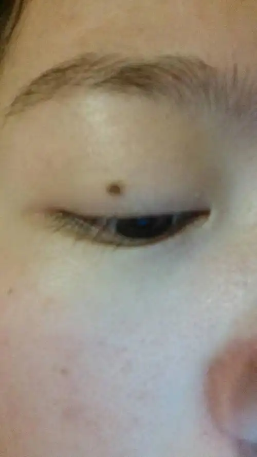眼皮上长了一颗痣,怕越长越大,而且影响美观,想去掉,又怕会伤害眼睛