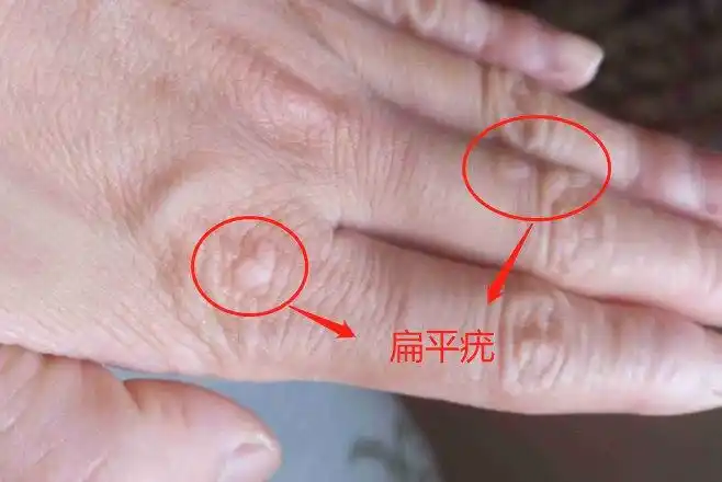 手背扁平疣